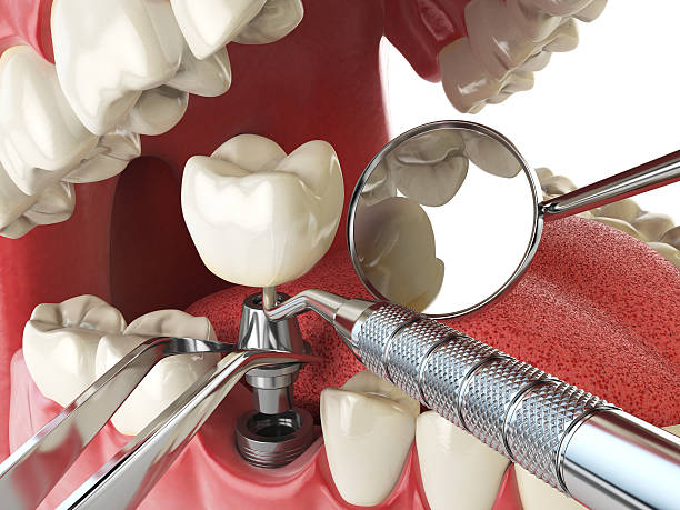 Best Emergency Broken Tooth Repair in Plattsmouth, NE